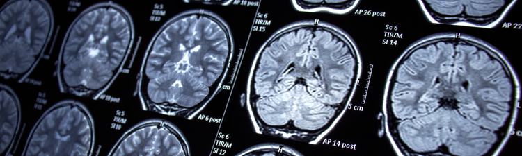 neurology, epilepsy, magnetic resonance imaging, mri, seizure, health